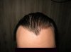 Present Hairline (Full Front Shot).jpg