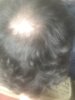 hair loss 1.jpg