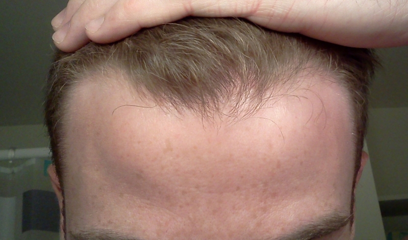 hairlinefront11.jpg