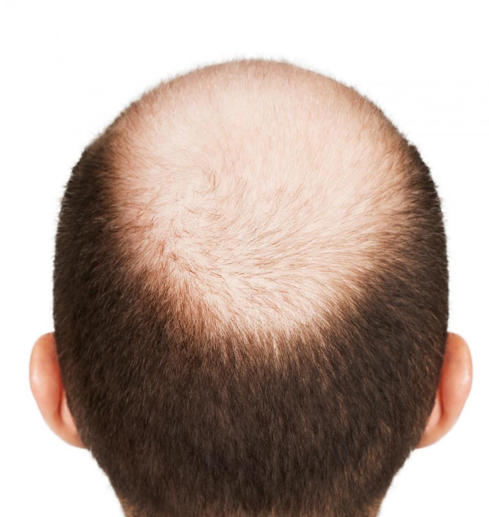 male-pattern-baldness2.jpeg