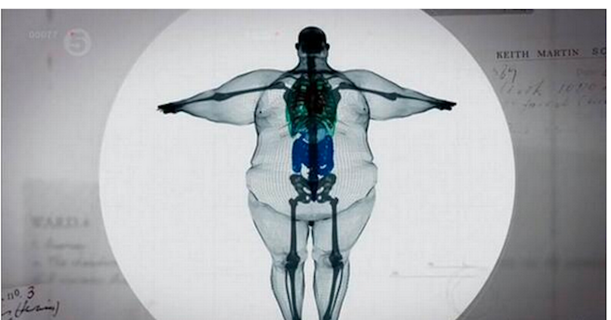 FAT-MRI.png