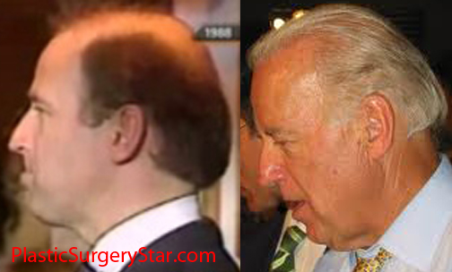 joe-biden-hair-transplant.jpg