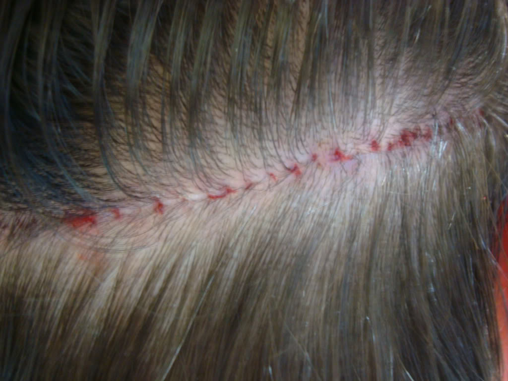 StitchedRemoved1weekpostop.jpg