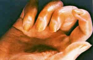 scleroderma.jpg