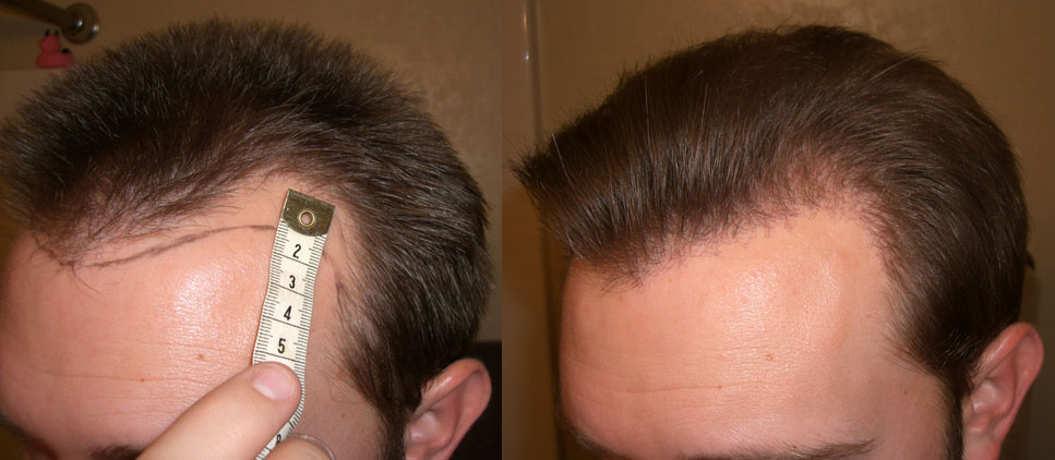 hairline-left-4mths.jpg