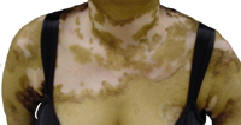vitiligo-chest.jpg
