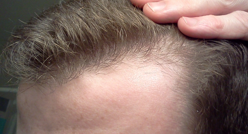 hairlineleft2.jpg