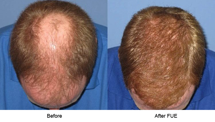 FUE%20before%20and%20after%202.jpg