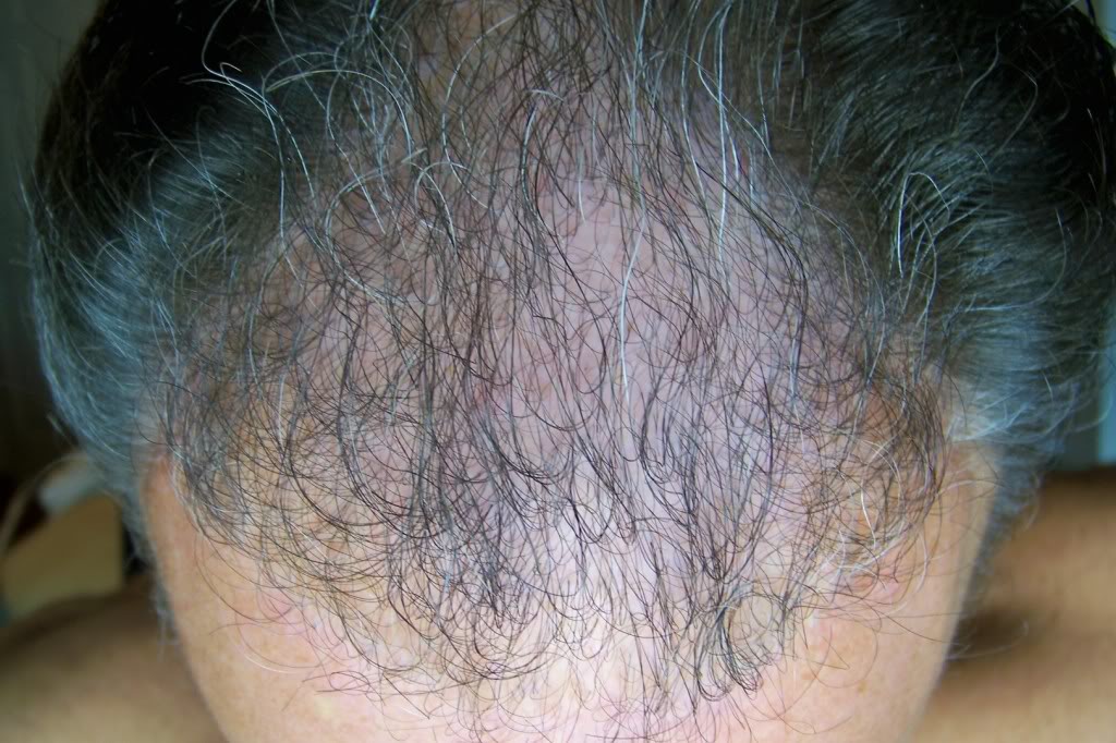 Should I Use Nape Hair For My Hairline? [pics] | HairLossTalk Forums