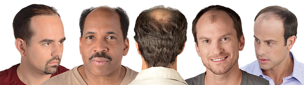 male-pattern-baldness.jpg