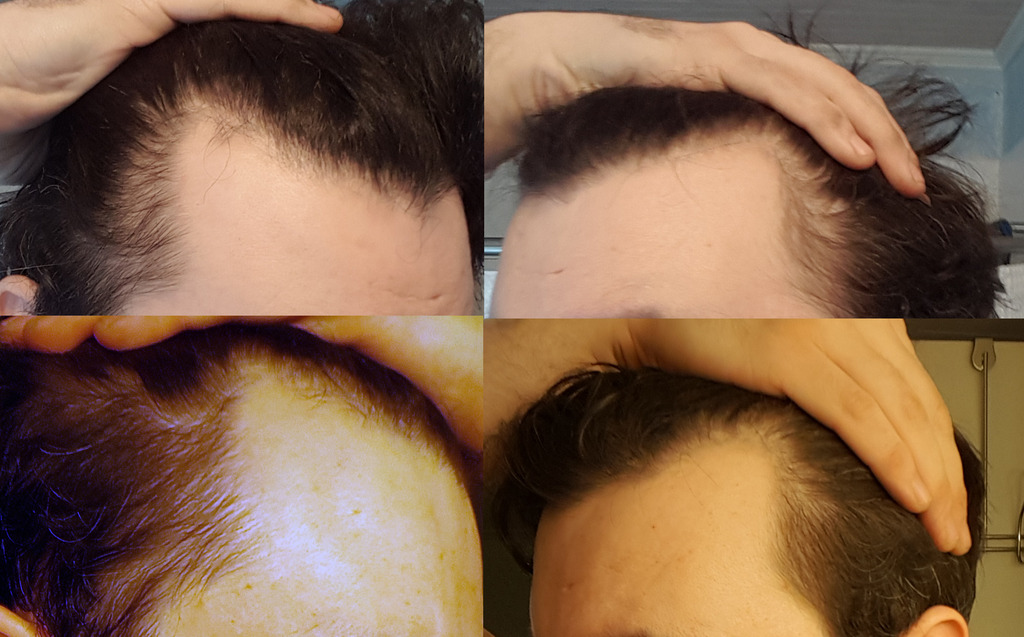 hairlinebasenow.jpg