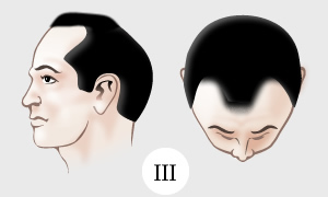 alopecia3.jpg