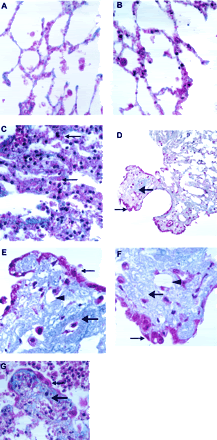 lungfibrosis.gif