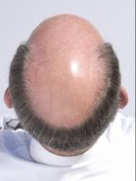 thump_6306449malepatternbaldness.jpg