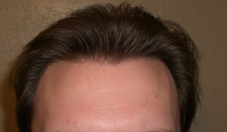 1yr-hairline.jpg