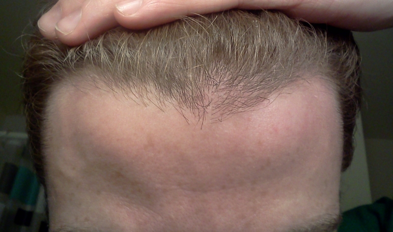 hairlinefront22.jpg