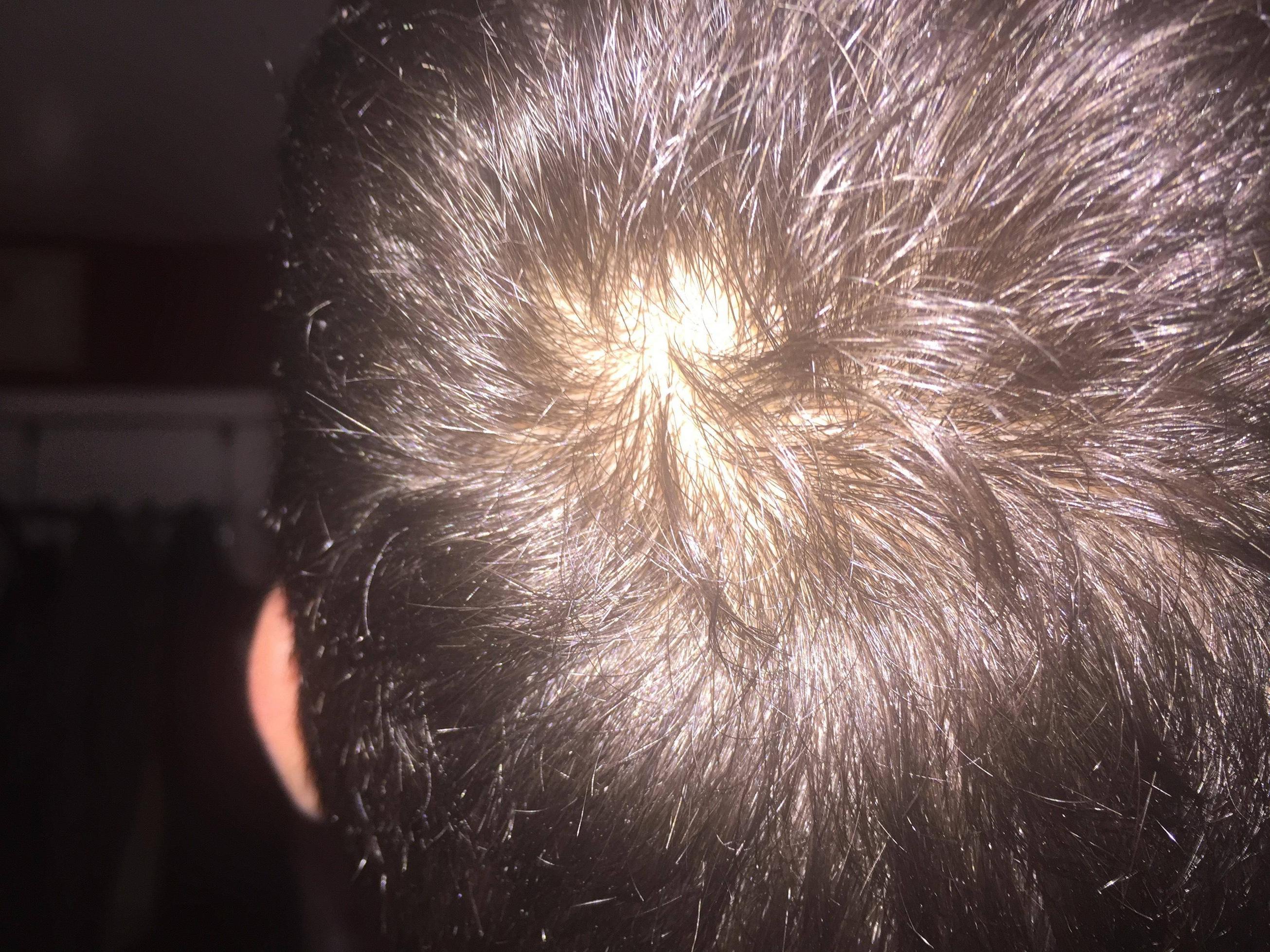 Is It Normal To Have A Tiny Bald Spot