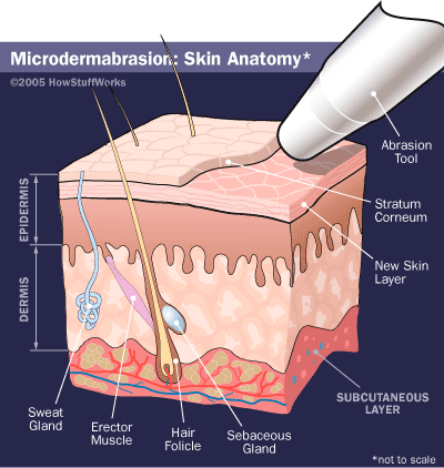 microdermabrasion-2.gif