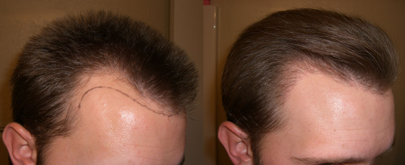 hairline-right-4mths.jpg