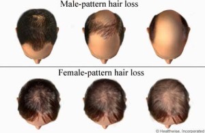 male-female-pattern-baldness-300x195.jpg